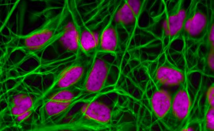 Research suggests calcium movement in cells goes awry in both breast cancers and metastatic tumours in the brain Research suggests calcium movement in cells goes awry in both breast cancers and metastatic tumours in the brain